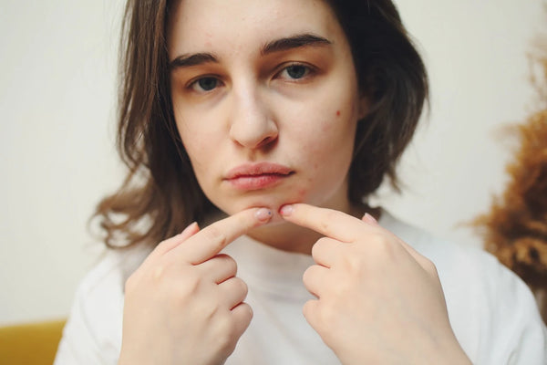 Acne Marks vs. Scars: Know the Difference for Clearer Skin