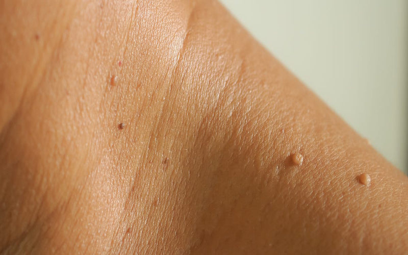 Skin Tags: Causes & How to Remove Them