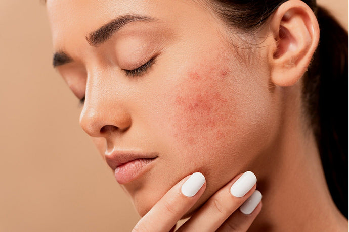 5 DIY Remedies to Get Rid of Acne